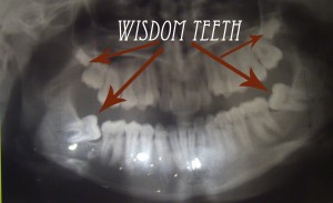 xray1 Apparently my bottom 12 year molars never came in, and my wisdom teeth are filling in for them...side ways.